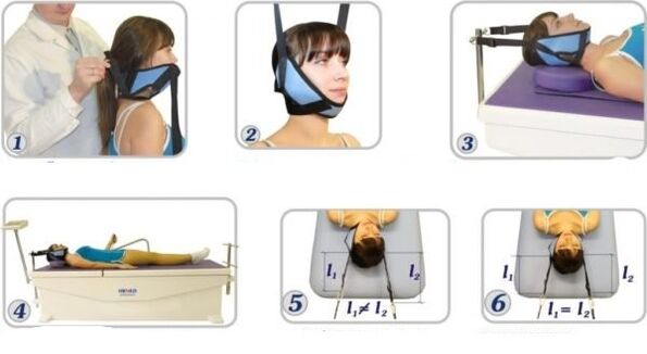 Dzemdes kakla osteohondrozes ārstēšana ar elimināciju