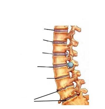 Osteohondrozes attīstības posmi
