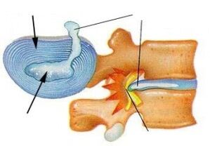 Šķiedru gredzena iznīcināšana ar dzemdes kakla osteohondrozi