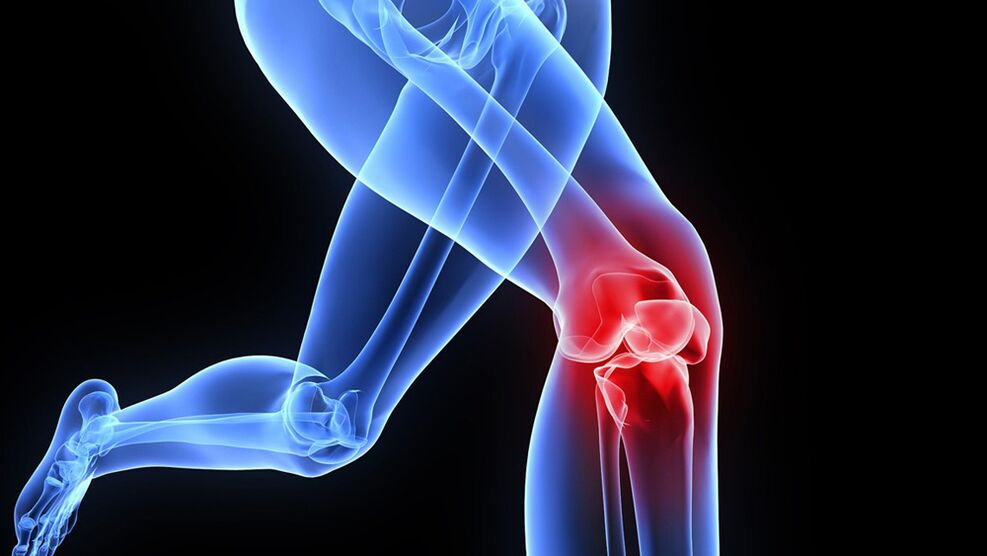 problēmas ar ceļiem artrozes dēļ