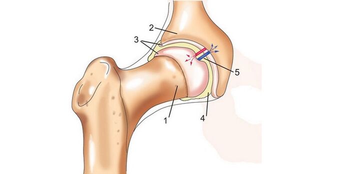 gūžas locītava un artroze