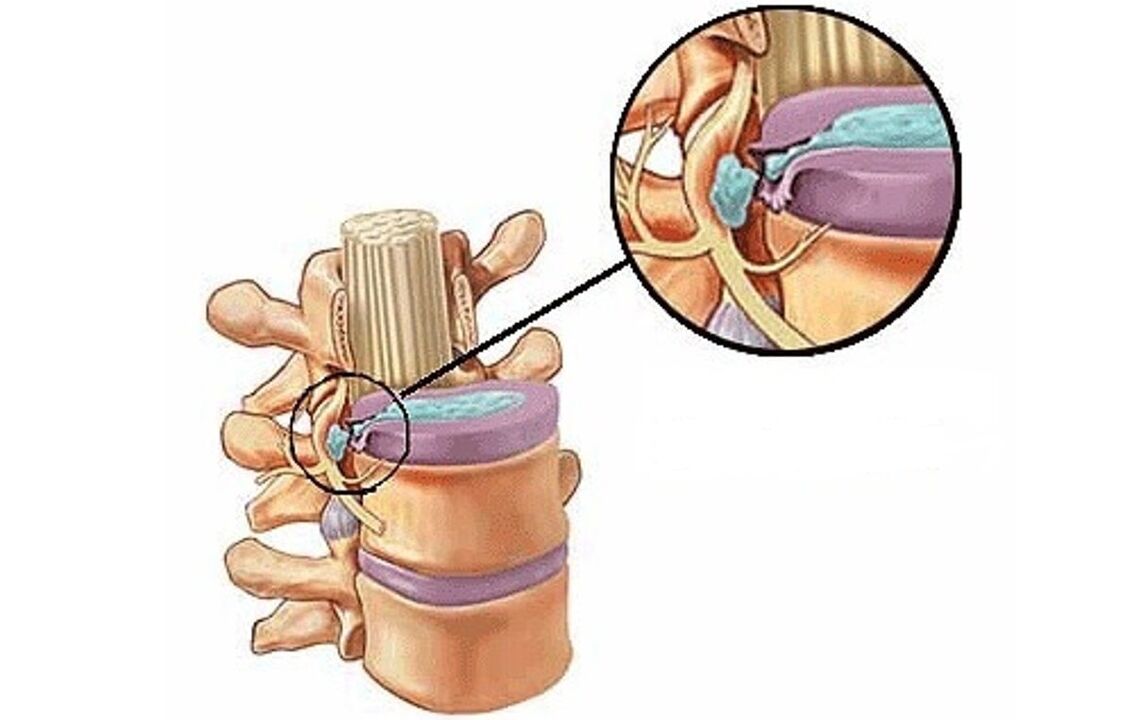 starpskriemeļu trūce ar krūšu kurvja osteohondrozi